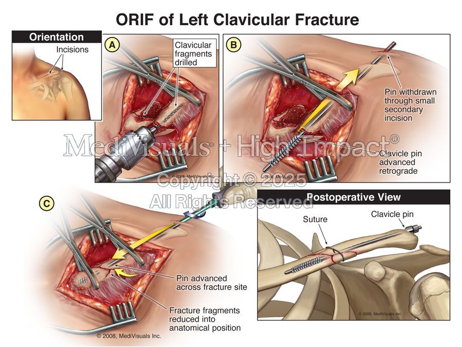 ORIF of Left Clavicular Fracture