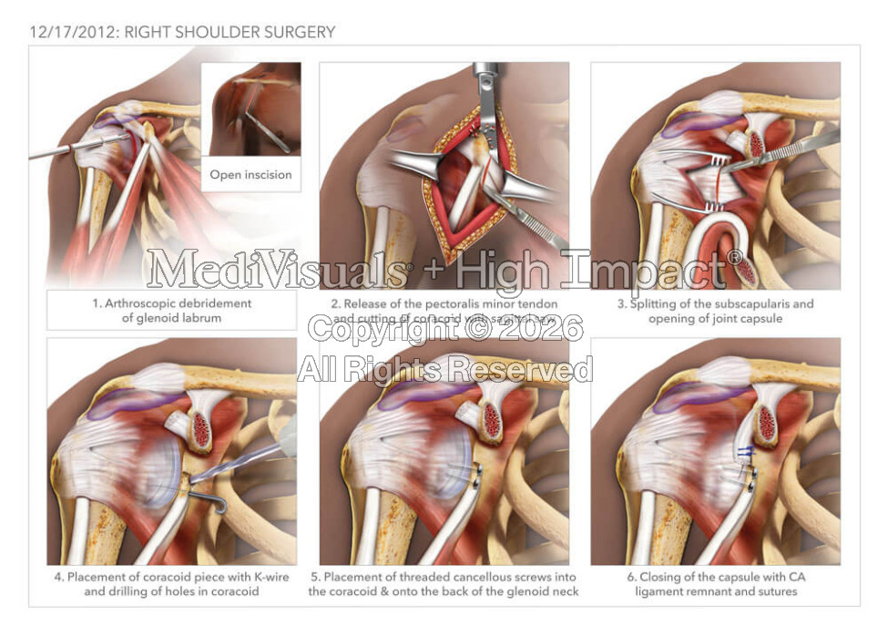 Shoulder Surgery