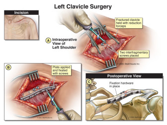Left Clavicle Surgery