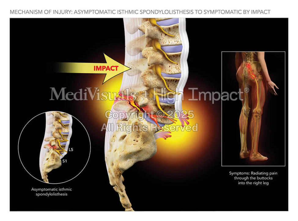 Asymptomatic Isthmic Spondylolisthesis to Symptomatic by Impact