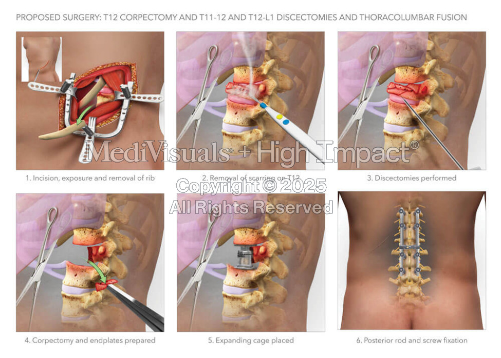 Corpectomy, Discectomies, Fusion