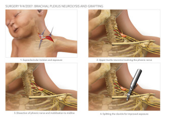 Brachial Plexus Neurolsysis