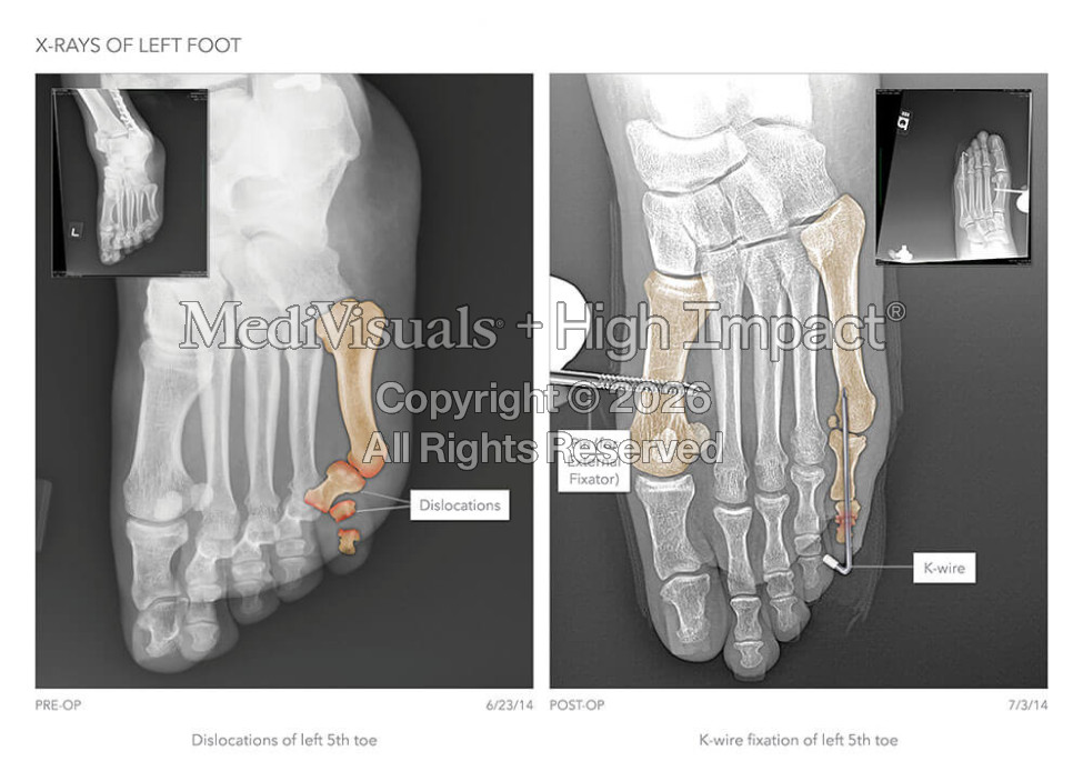 X-Rays of Left Foot