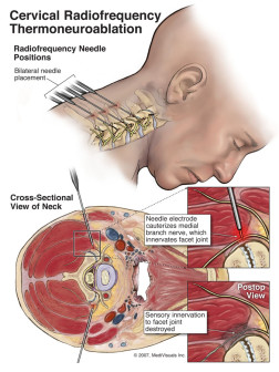 Cervical Radiofrequency Thermoneuroablation