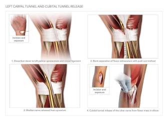 Left Carpal Tunnel and Cubital Tunnel Release