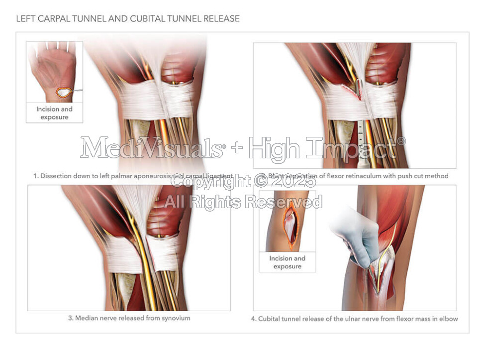 Left Carpal Tunnel and Cubital Tunnel Release