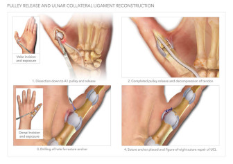 Pulley Release and Ulnar Collateral Ligament Reconstruction