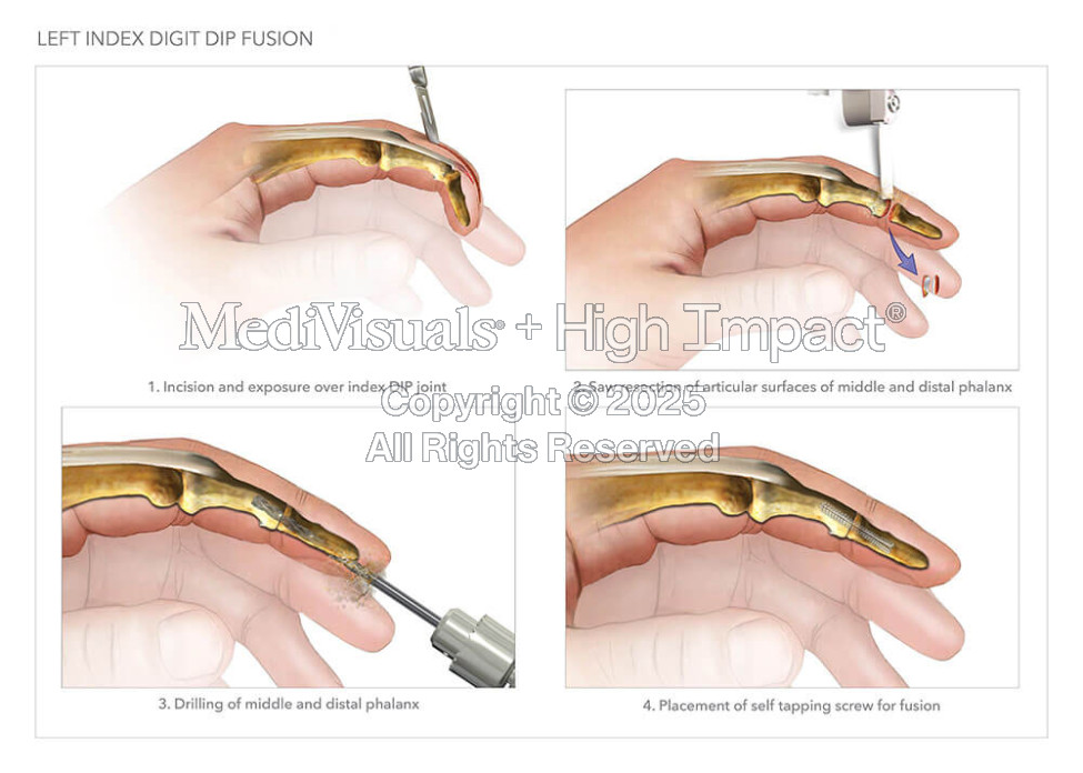 Left Index Digit Dip Fusion