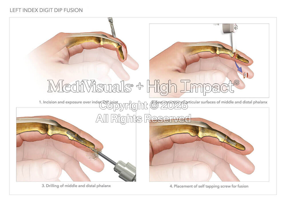 Left Index Digit Dip Fusion