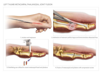 Left Thumb Metacarpal Phalangeal Joint Effusion
