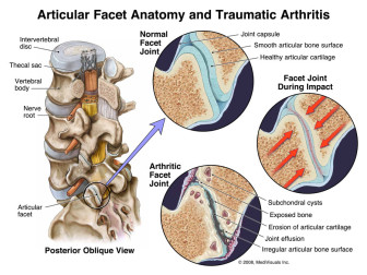 Articular Facet Anatomy and Traumatic Arthritis