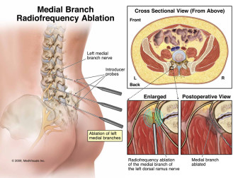 Medial Branch Radiofrequency Ablation