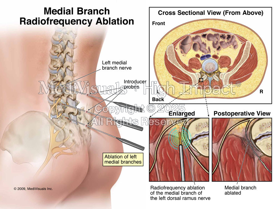 Medial Branch Radiofrequency Ablation