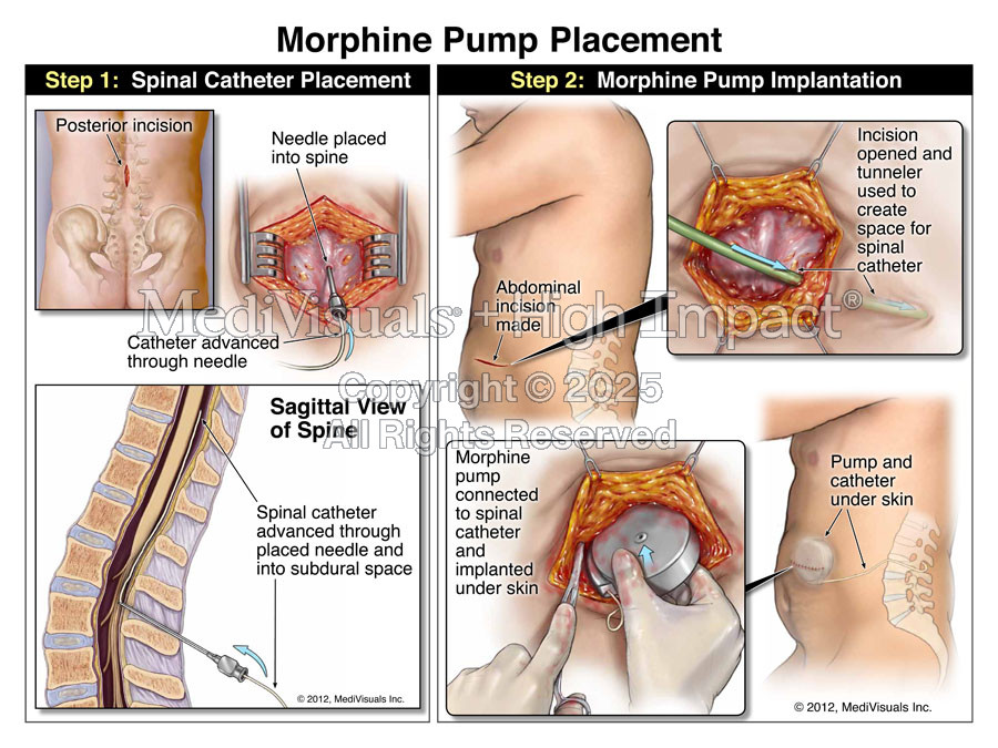 Morphine Pump Placement
