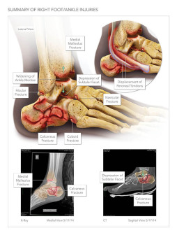 Summary of Right Foot/Ankle Injuries