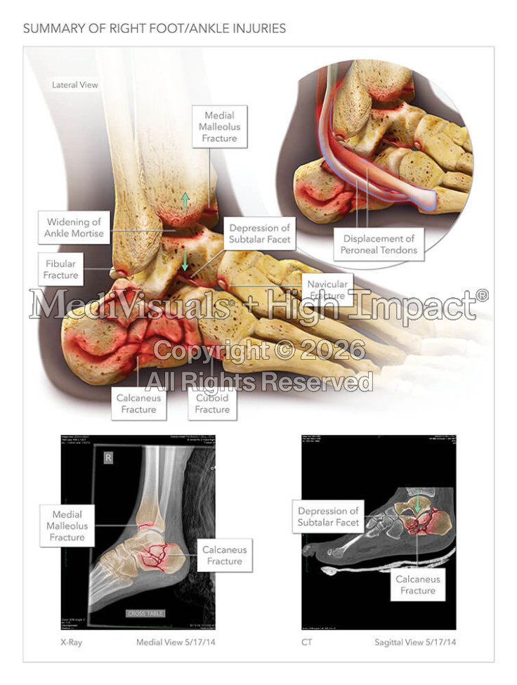 Summary of Right Foot/Ankle Injuries