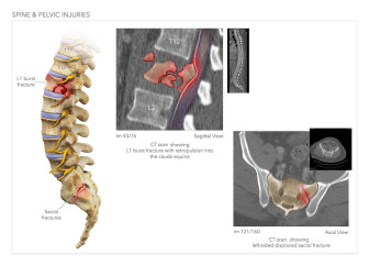 Spine and Pelvic Injuries