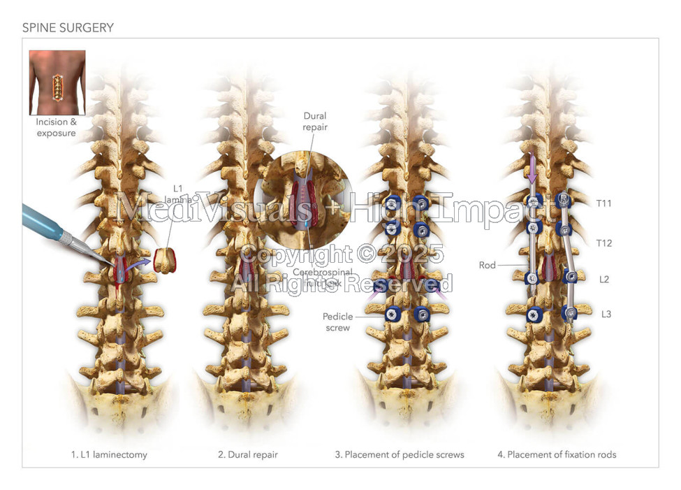 Laminectomy with Poster Fixation