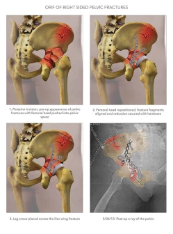 ORIF of Right Sided Pelvic Fractures