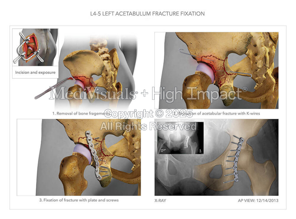 L4-5 Left Acetabulum Fracture Fixation