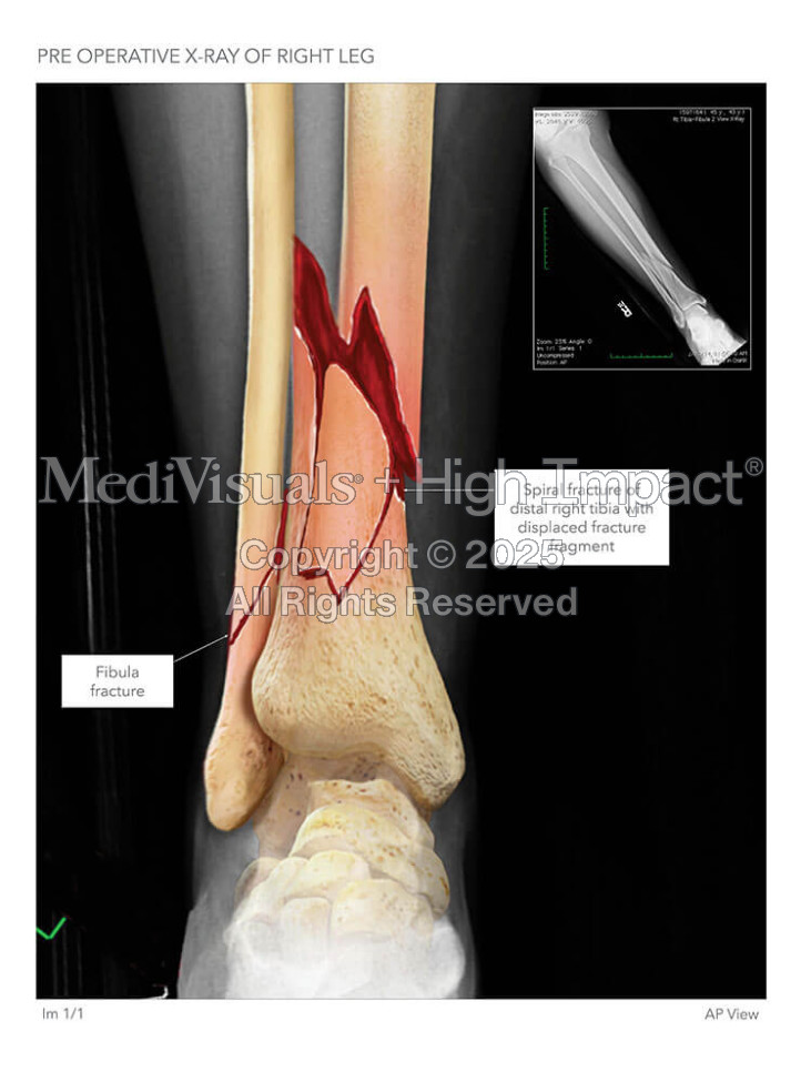Pre-Operative X-Ray of Right Leg