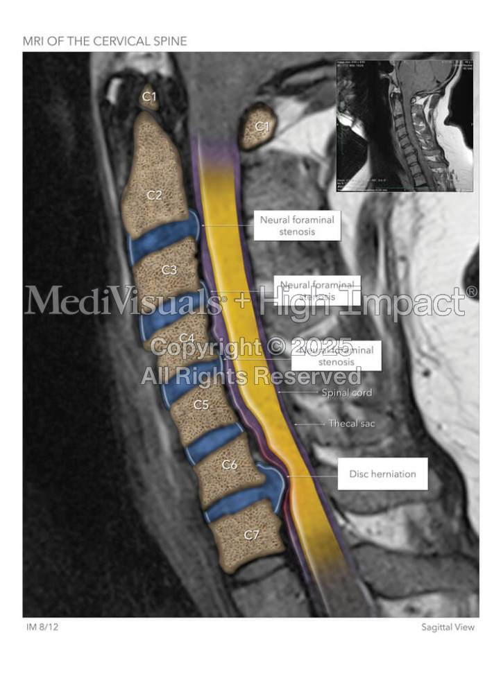 MRI of the Cervical Spine