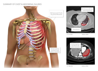 Summary of Chest & Abdominal Injuries