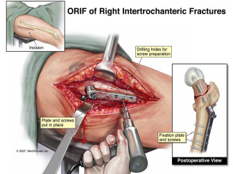 ORIF of Right Intertrochanteric Fractures