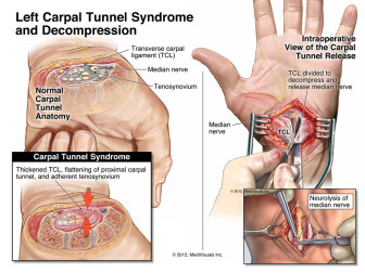Left Carpal Tunnel Syndrome and Decompression