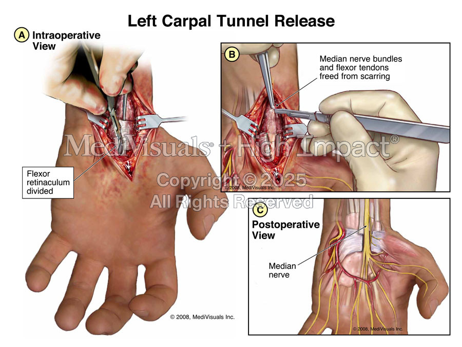 Left Carpal Tunnel Release