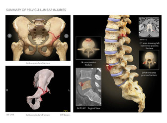 Summary of Pelvic & Lumbar Injuries