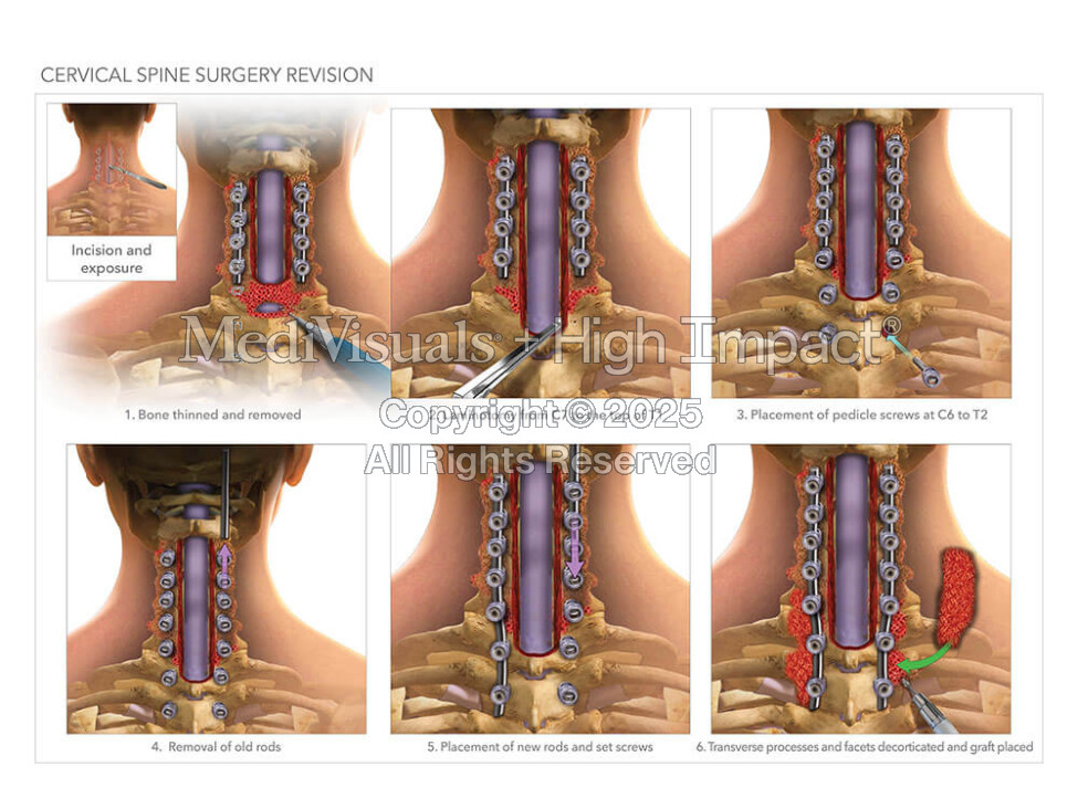 Cervical Spine Surgery Revision