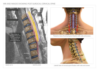MRI and Images Showing Post-Surgical Cervical Spine