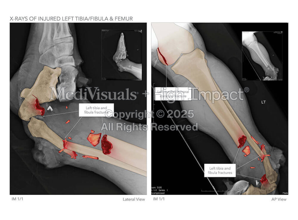 X-Rays of Injured Left Tibia/Fibula & Femur