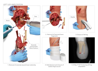 Left Leg Amputation