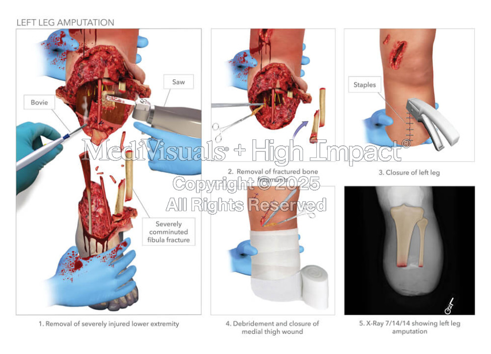 Left Leg Amputation