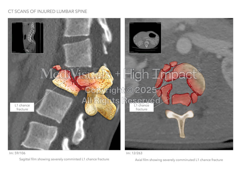 CT Scans of Injured Lumbar Spine