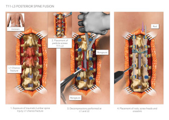 T11-L3 Posterior Spine Fusion