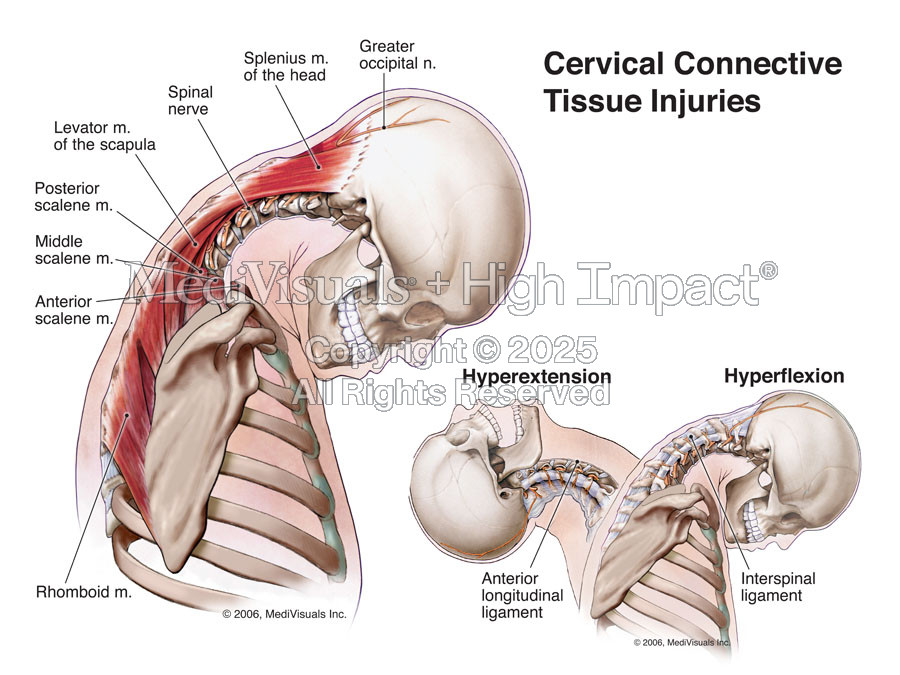 Cervical Connective Tissue Injuries