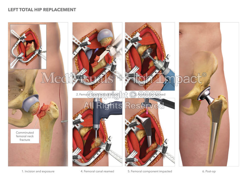Left Total Hip Replacement