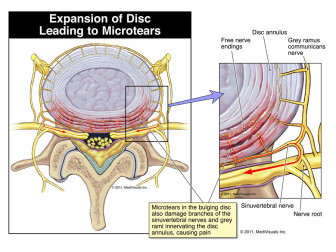 Expansion of Disc Leading to Microtears
