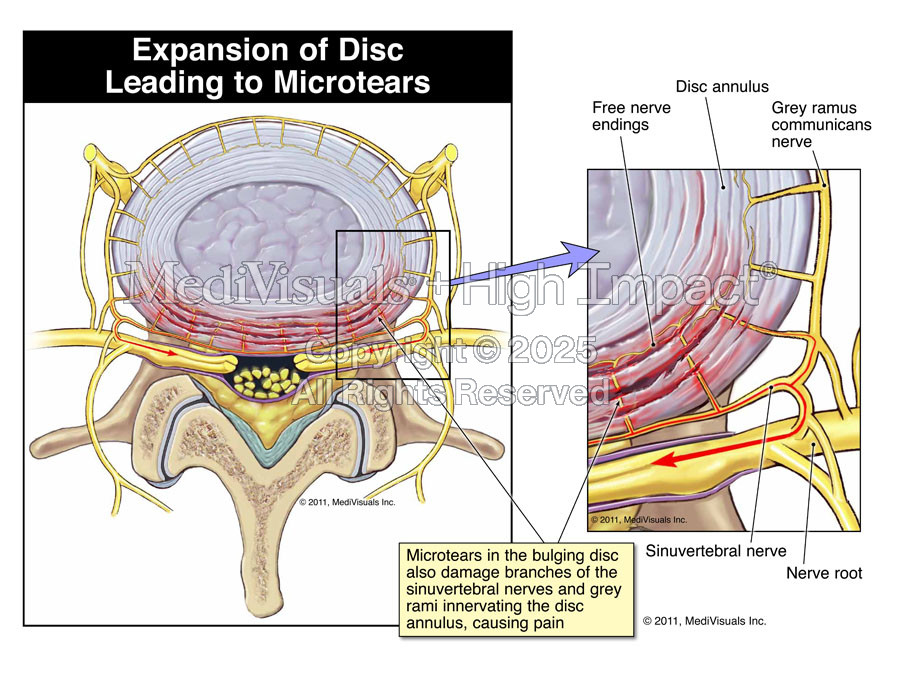Expansion of Disc Leading to Microtears