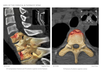 MRIs of the Cervical & Thoracic Spine