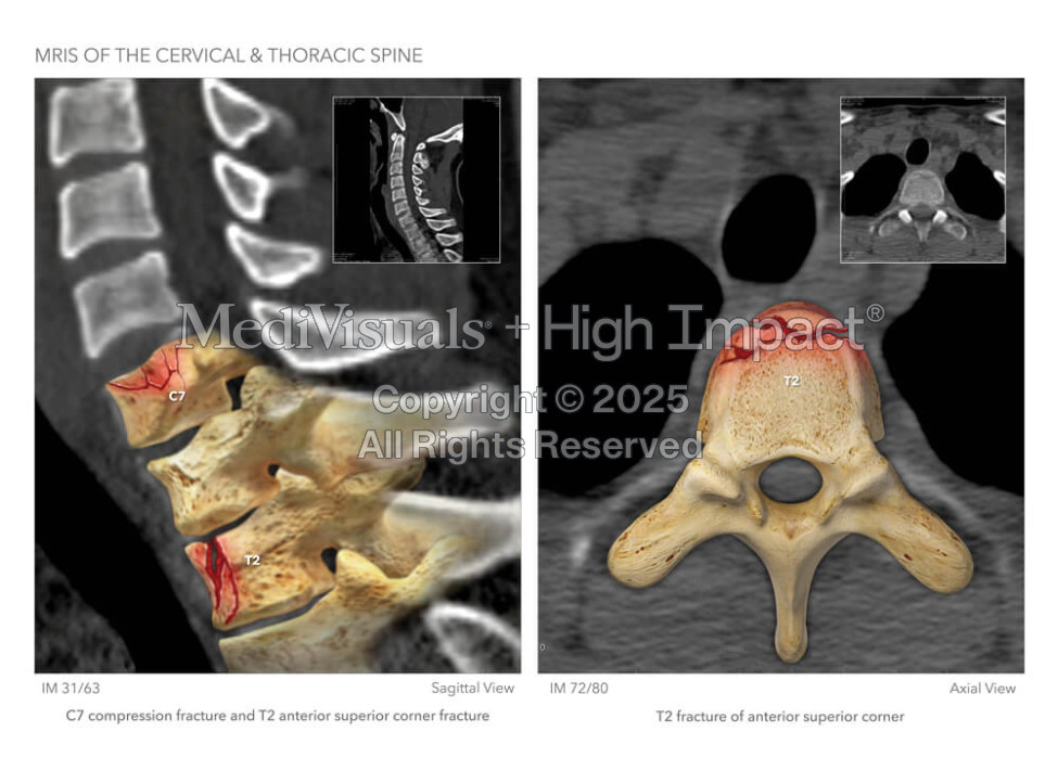 MRIs of the Cervical & Thoracic Spine
