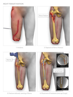 Right Femur Fixation