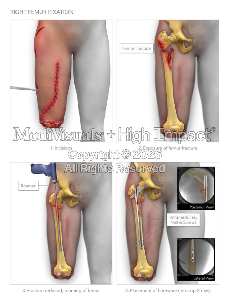 Right Femur Fixation