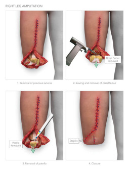 Right Leg Amputation