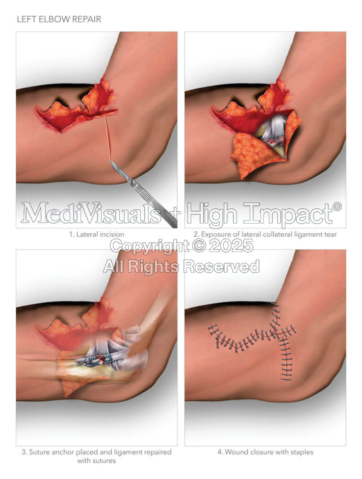 Left Elbow Repair