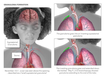 Granuloma Formation