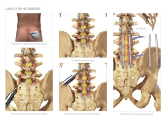 Lumbar Spine Surgery